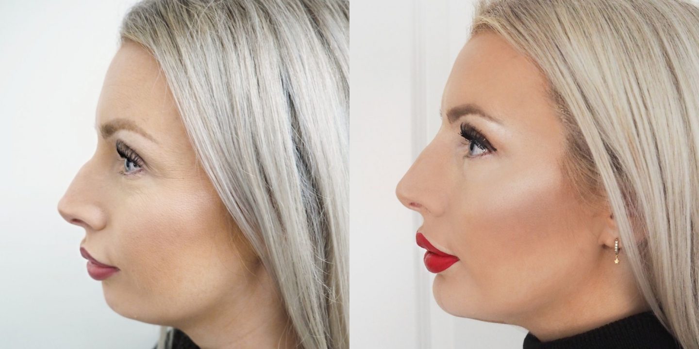 I’ve had Injectables – with Before & After Pics